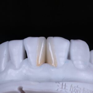 Emax veneer Top tech China Dental lab