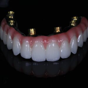 All on 4 All on 6 All on X Full Arch implant China Dental lab (1)