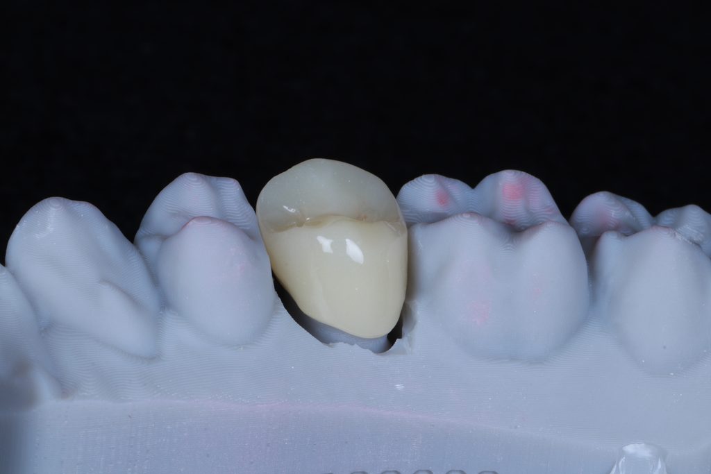 China dental lab price list and CAD CAM restoration cost comparison