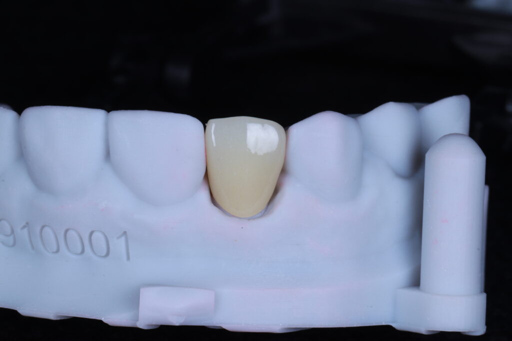 china-dental-lab-anterior-zirconia-crown
