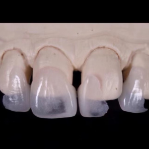 Emax Veneer China Dental Lab