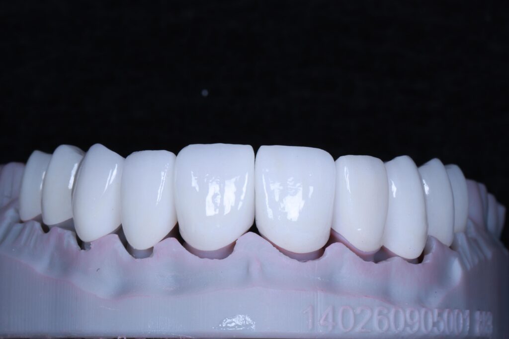Zirconia crowns&bridge China dental lab