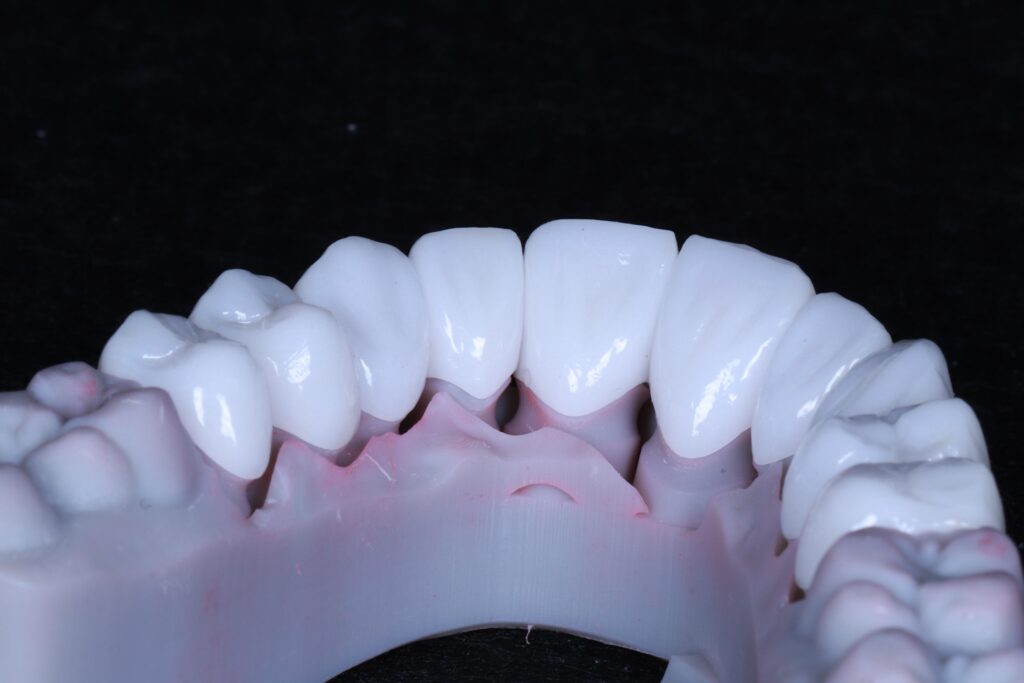Zirconia Crowns&Bridge China Dental Lab